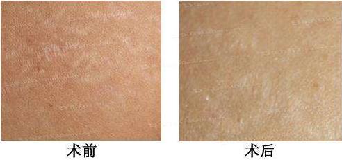 做激光去妊娠紋的果好不好？針對(duì)寶媽產(chǎn)后