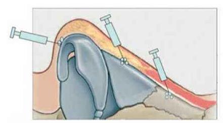 耳軟骨隆鼻尖手術(shù)，時間久了會被吸收嗎？