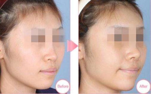 耳軟骨隆鼻尖手術(shù)，時間久了會被吸收嗎？