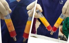 脂肪膠和普通的自體脂肪填充有什么區(qū)別？