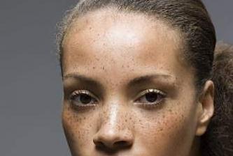 什么原因?qū)е铝嗣娌奎S褐斑產(chǎn)生？如何有的去除？