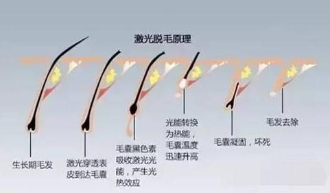 做激光脫毛有副作用嗎？有什么風險嗎？