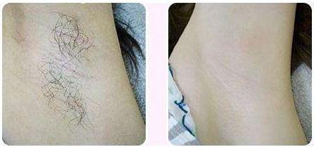 做激光脫毛有副作用嗎？有什么風險嗎？