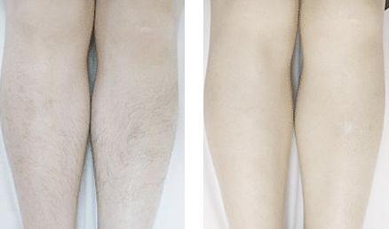 做激光脫毛有副作用嗎？有什么風險嗎？