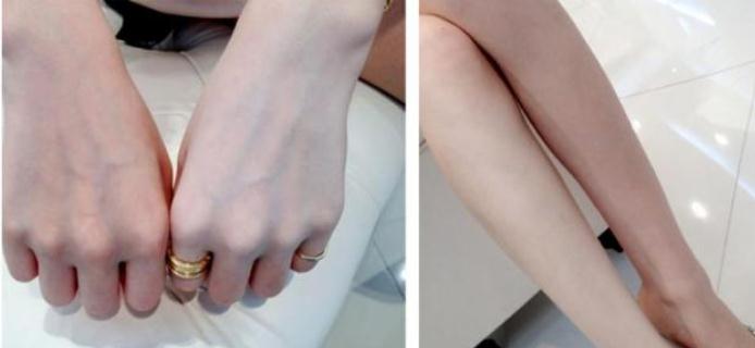 做全身光子美白果好嗎？有后遺癥嗎？