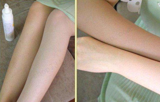 做全身光子美白果好嗎？有后遺癥嗎？