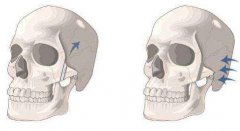 為什么有人做完顴骨手術后悔死了？真相大公開