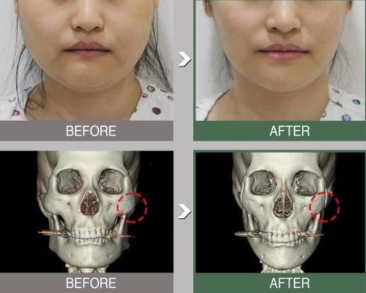 為什么有人做完顴骨手術后悔死了？真相大公開！