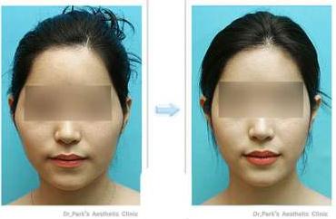 為什么有人做完顴骨手術后悔死了？真相大公開！