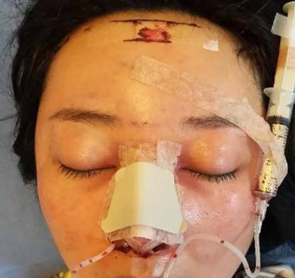 真人的假體隆鼻親身經(jīng)歷告訴你，隆鼻后鼻夾要帶多久？