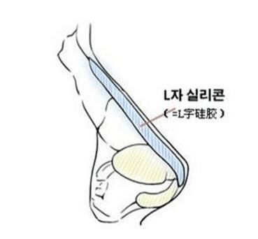 真人的假體隆鼻親身經(jīng)歷告訴你，隆鼻后鼻夾要帶多久？