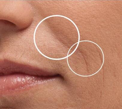 做玻尿酸去法令紋副作用有哪些？