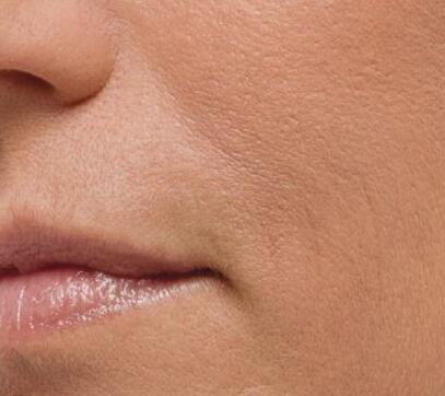 做玻尿酸去法令紋副作用有哪些？