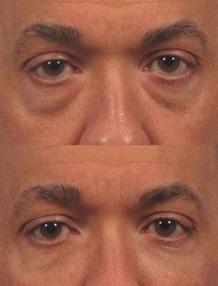 眼袋的形成原因？有哪些方法能有的去除？