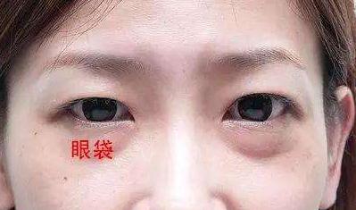 眼袋的形成原因？有哪些方法能有的去除？
