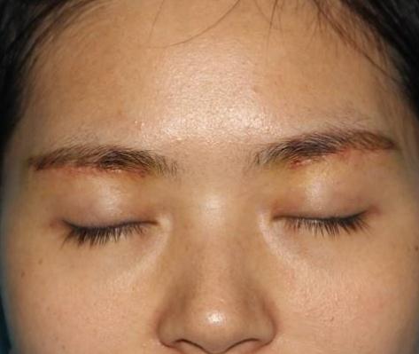 眼袋的形成原因？有哪些方法能有的去除？