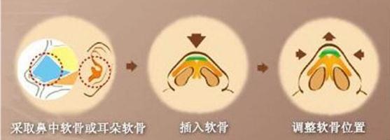 做的耳軟骨墊鼻尖萬一被撞歪了可以修復嗎?怎么修復？