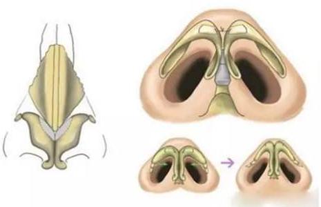 做的耳軟骨墊鼻尖萬一被撞歪了可以修復嗎?怎么修復？