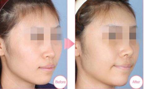 做的耳軟骨墊鼻尖萬一被撞歪了可以修復嗎?怎么修復？