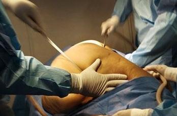 在吸脂豐胸術(shù)前，你需要要了解這些事實！