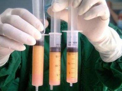 在吸脂豐胸術(shù)前，你需要要了解這些事實！