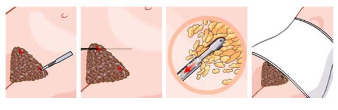 做完腰腹部吸脂之后，皮膚會(huì)不會(huì)變得松弛下垂？