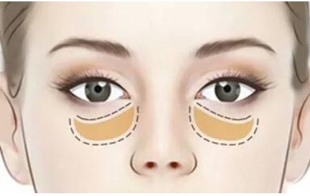 做外切去眼袋容易留疤，是真的嗎？