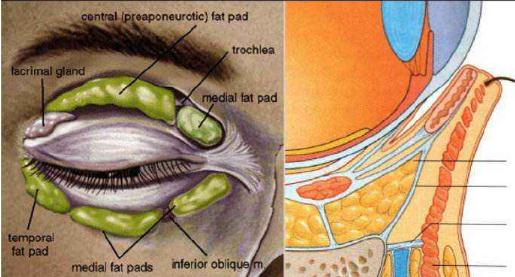 做外切去眼袋容易留疤，是真的嗎？