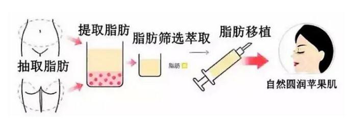 為什么有的人做了自體脂肪豐蘋果肌之后不好看呢？