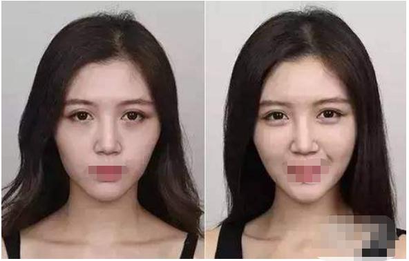 為什么有的人做了自體脂肪豐蘋果肌之后不好看呢？