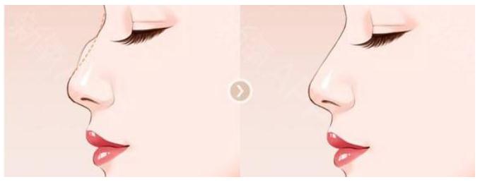 盡管駝峰鼻矯正不是什么大手術(shù)，但是還是得說一說后遺癥問題！