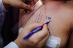 隆胸假體的尺寸應該怎樣選擇呢？挑選適合自己