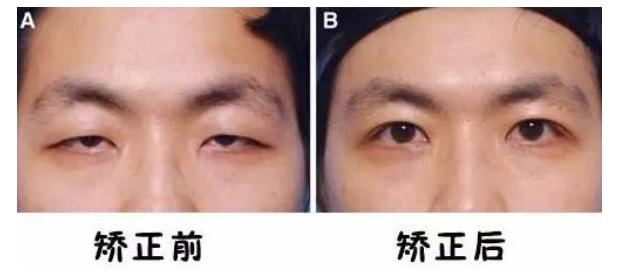 上眼瞼下垂必須要做上瞼提肌手術(shù)嗎？果咋樣？