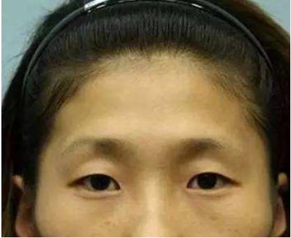 擔(dān)心有副作用，額頭凹陷填充玻尿酸好不好？