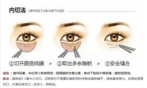 遺傳性眼袋應(yīng)該怎樣有去除？?jī)?nèi)切和外切了解一下~