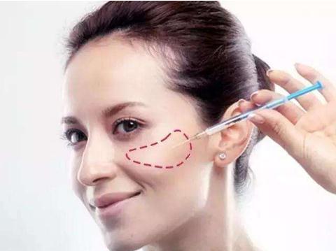 蘋果肌填充自體脂肪之后，脂肪多久變得穩(wěn)定？