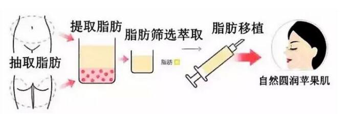 蘋果肌填充自體脂肪之后，脂肪多久變得穩(wěn)定？