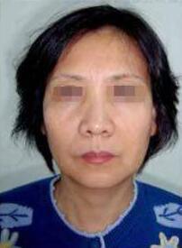 光子嫩膚能維持的時(shí)間跟什么有關(guān)？