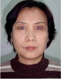 光子嫩膚能維持的時(shí)間跟什么有關(guān)？