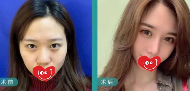 取肋軟骨對身體功能有影響嗎?