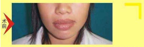 薄唇變厚術(shù)