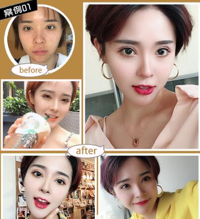 割完雙眼皮需要的注意事項(xiàng)