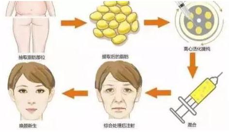 做完自體脂肪填充后沒有果，做二填的果怎么樣？