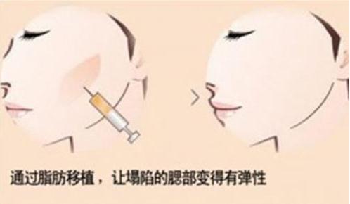 做完自體脂肪填充后沒有果，做二填的果怎么樣？