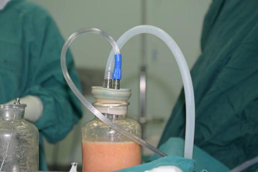 想要擁有身材，全身吸脂手術的危害性大不大？