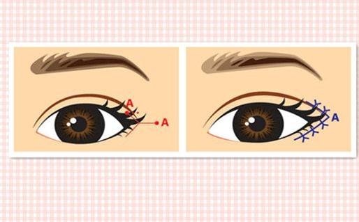 開外眼角手術(shù)盡管能放大雙眼，但是后遺癥也要了解一下！