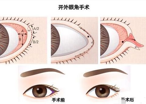 開外眼角手術(shù)盡管能放大雙眼，但是后遺癥也要了解一下！