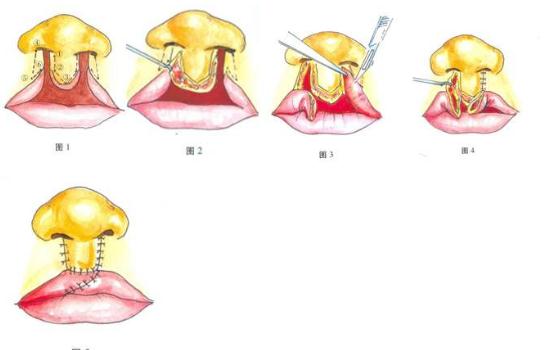 患有唇腭裂的影響，矯正應(yīng)該盡早進行~