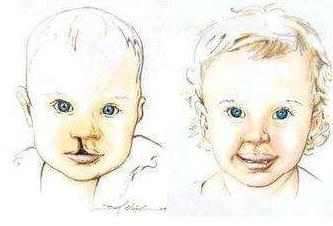 患有唇腭裂的影響，矯正應(yīng)該盡早進行~