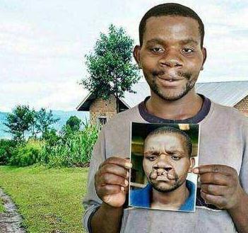 患有唇腭裂的影響，矯正應(yīng)該盡早進行~